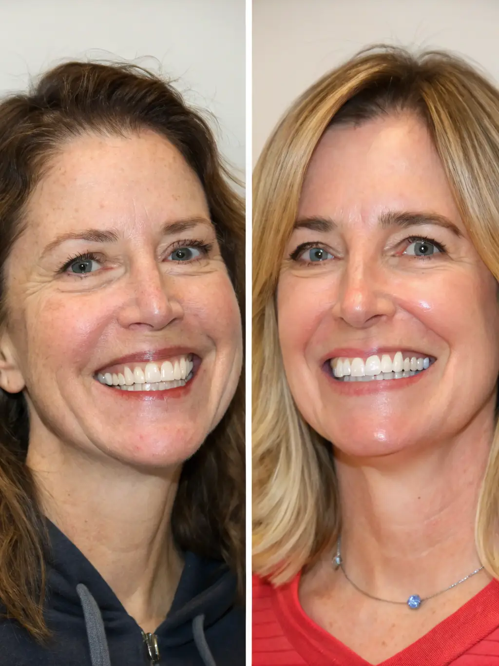 A before-and-after image showcasing a patient's smile transformation after receiving dental crowns at TellerDental, highlighting the aesthetic and functional benefits.