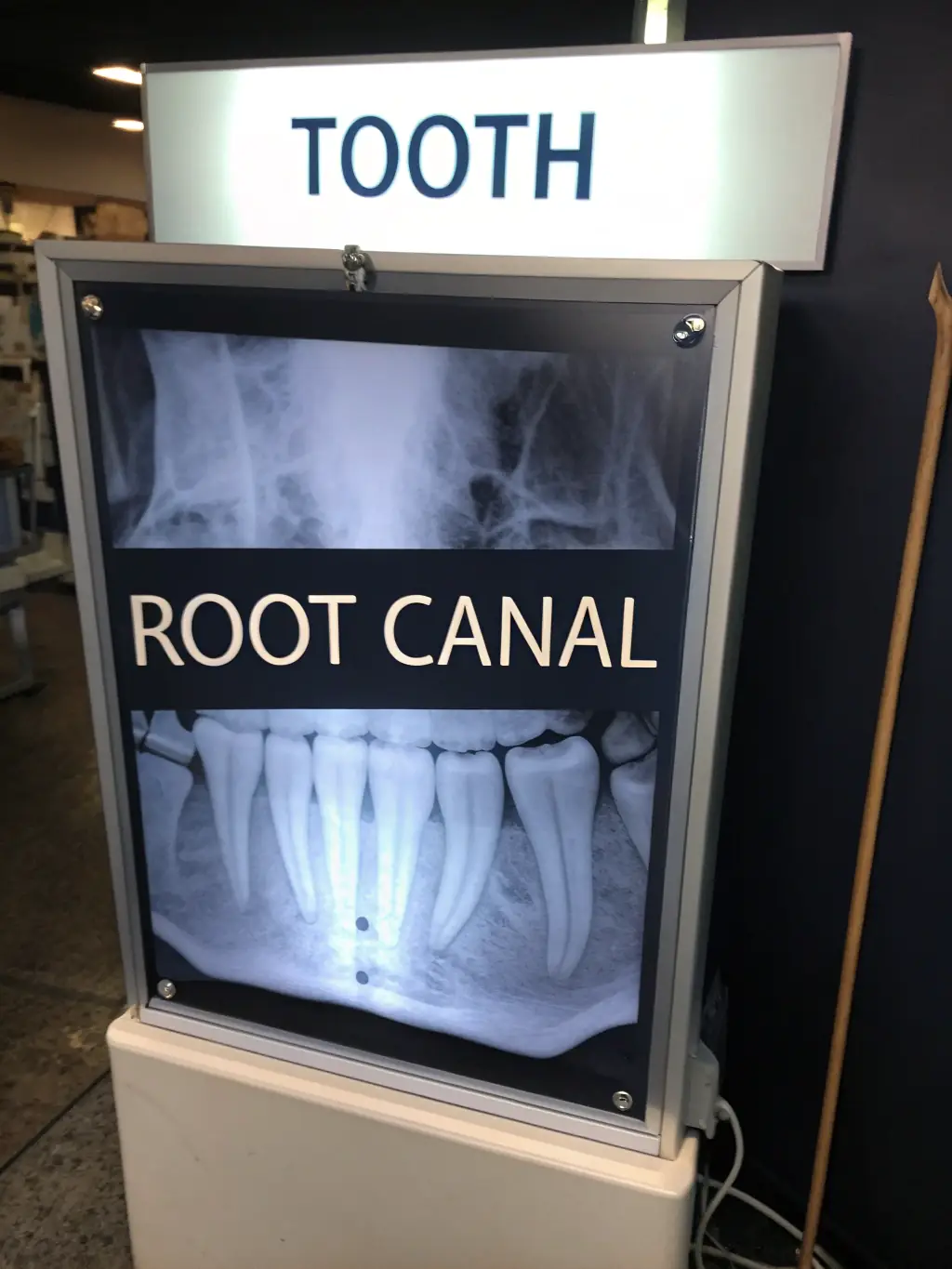 An x-ray image showing a tooth undergoing a root canal procedure, illustrating the removal of infected pulp and the sealing of the tooth at TellerDental.